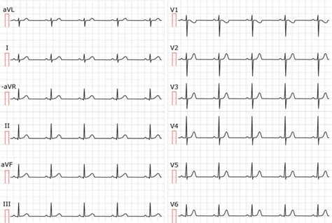 ecg nsr means|Sinus rhythm: physiology, ECG criteria & clinical implications.